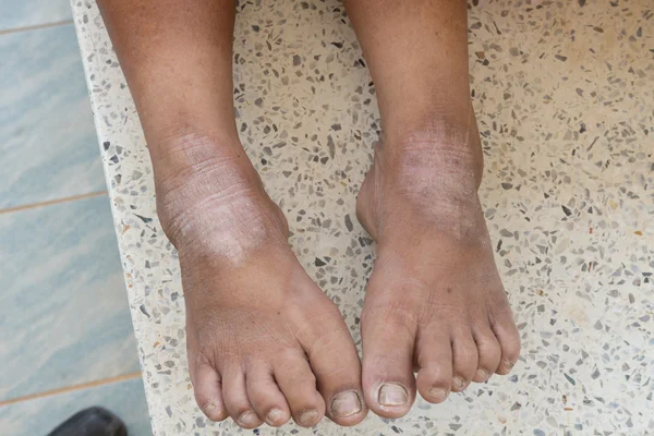 Skin disorder on foot