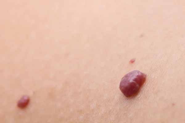 İnsan derisindeki benin yakın çekimi..