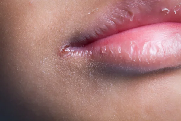 Kątowe Zapalenie Warg Zapalenie Jamy Ustnej Brak Witamin Pojęcie Słabości — Zdjęcie stockowe