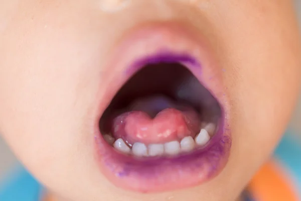 El Ayak Agiz Hastaligi çocuk