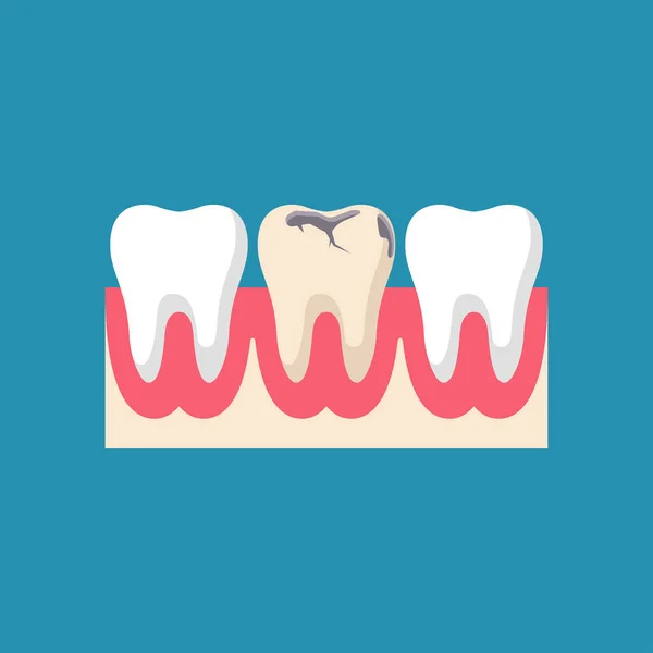 Dentes saudáveis e doentes na boca na gengiva. —  Vetores de Stock