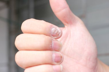 Çivi yandan, parmak Onikomikoz ile mantar enfeksiyonu. -yumuşak odak