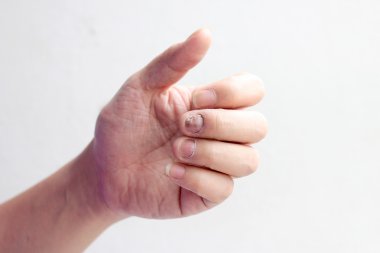 Çivi yandan, parmak Onikomikoz ile mantar enfeksiyonu. -yumuşak odak