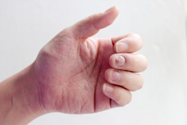 Çivi yandan, parmak Onikomikoz ile mantar enfeksiyonu. -yumuşak odak