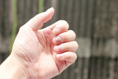 Çivi yandan, parmak Onikomikoz ile mantar enfeksiyonu. -yumuşak odak