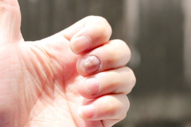 Çivi yandan, parmak Onikomikoz ile mantar enfeksiyonu. -yumuşak odak