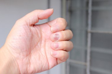 Çivi yandan, parmak Onikomikoz ile mantar enfeksiyonu. -yumuşak odak