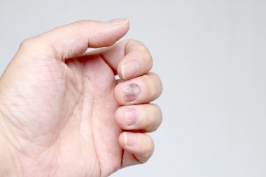 Çivi yandan, parmak Onikomikoz ile mantar enfeksiyonu. -yumuşak odak