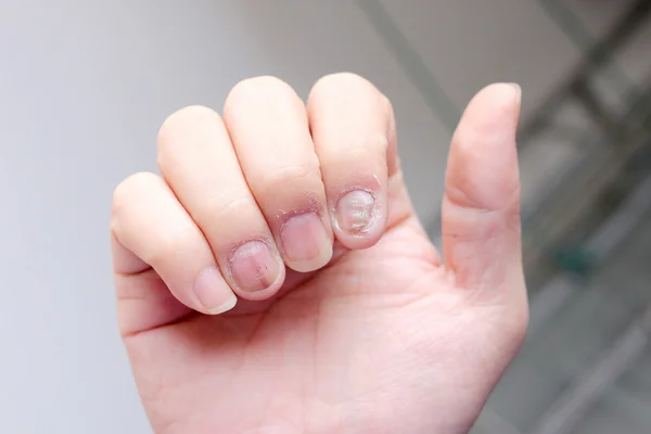 Schimmel Infectie Nagels Hand Vinger Met Onychomycosis Soft Focus Sea — Stockfoto