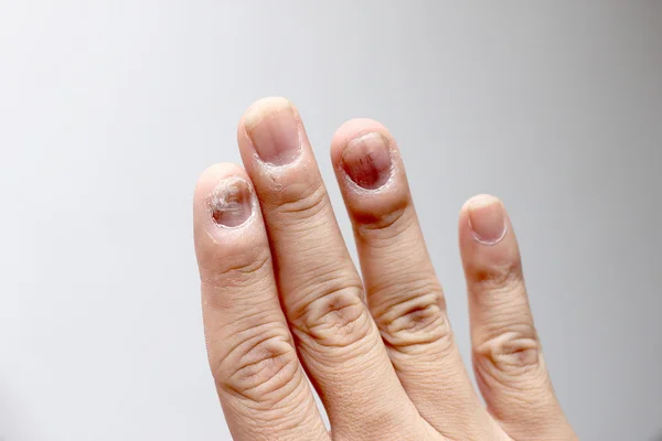 Infecção Fúngica Nas Unhas Mão Dedo Com Onicomicose Foco Suave — Fotografia de Stock