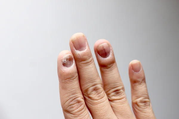 Infecção Fúngica Nas Unhas Mão Dedo Com Onicomicose Foco Suave — Fotografia de Stock