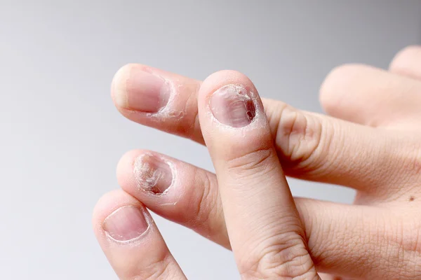 Fungus Infection Nails Hand Finger Onychomycosis Soft Focus — Stock Photo, Image