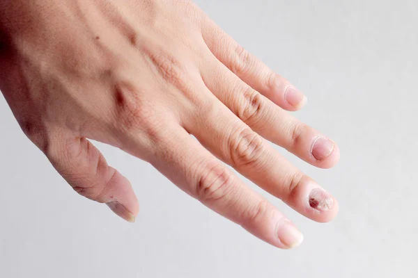 爪の手 指爪真菌症の真菌感染症 ソフト フォーカス — ストック写真