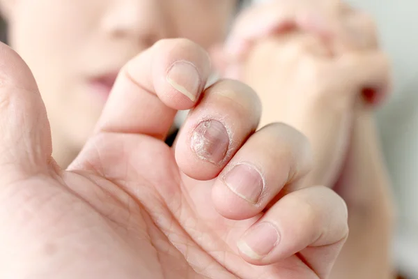 Infección Por Hongos Las Uñas Mano Dedo Con Onicomicosis Enfoque — Foto de Stock