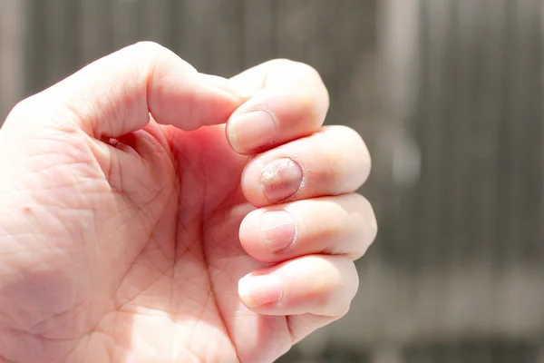 Infecção Fúngica Nas Unhas Mão Dedo Com Onicomicose Foco Suave — Fotografia de Stock