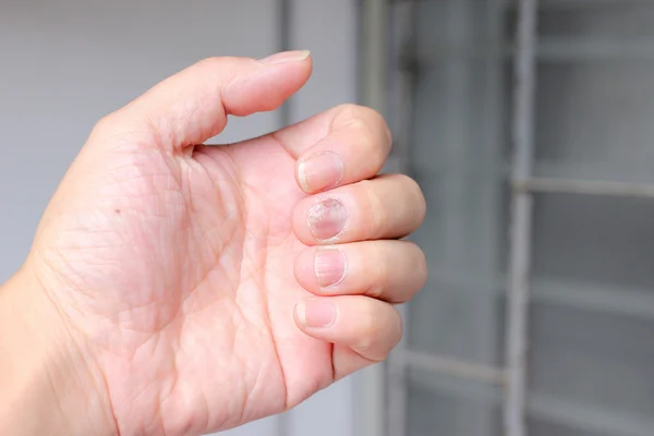 Fungus Infection Nails Hand Finger Onychomycosis Soft Focus — Stock Photo, Image