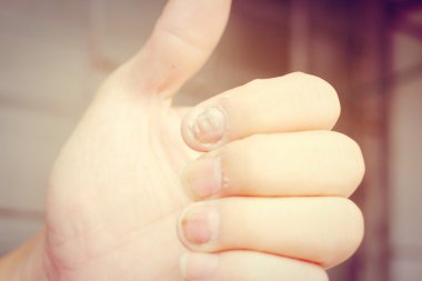 Çivi yandan, parmak Onikomikoz ile mantar enfeksiyonu. -sof