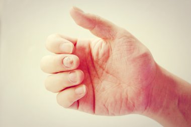 Çivi yandan, parmak Onikomikoz ile mantar enfeksiyonu. -sof