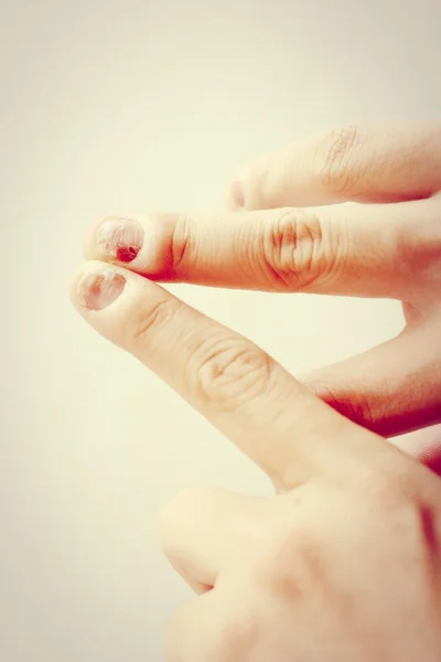Infezione da funghi sulla mano ungueale, dito con onicomicosi. - sof — Foto Stock