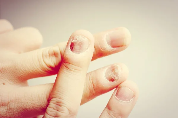 Інфекція грибка на нігтях Рука, Палець з оніхомікозом. - Софі — стокове фото