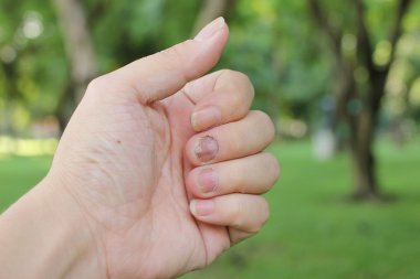 Mantar enfeksiyonu çivi yandan, Onikomikoz parmakla. 