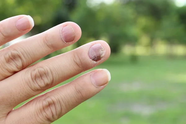 Infezione Funghi Sulla Mano Ungueale Dito Con Onicomicosi — Foto Stock