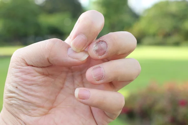 Fungus Infection Nails Hand Finger Onychomycosis — Stock Photo, Image