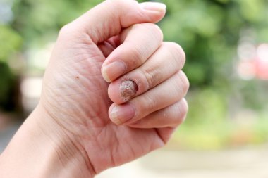 Fungus Infection on Nails Hand, Finger with onychomycosis, A toenail fungus. - soft focus clipart