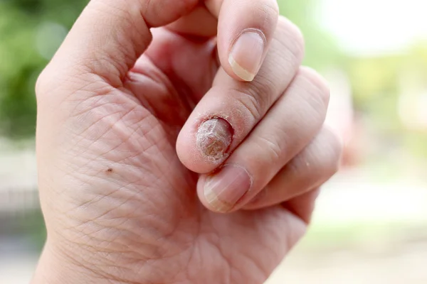 Infecção por fungos nas unhas Mão, dedo com onicomicose, um fungo nas unhas dos pés. - foco suave — Fotografia de Stock