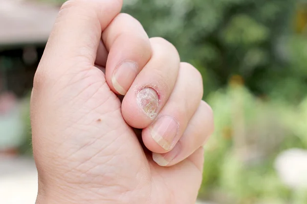 Fungus Infection on Nails Hand, Finger with onychomycosis, A toenail fungus. - soft focus