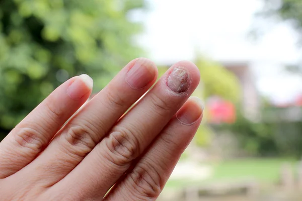 Грибковая инфекция на ладони, палец с онихомикозом, грибок на ногтях. - мягкая направленность — стоковое фото