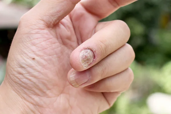 Fungus Infection on Nails Hand, Finger with onychomycosis, A toenail fungus. - soft focus — Stock Photo, Image