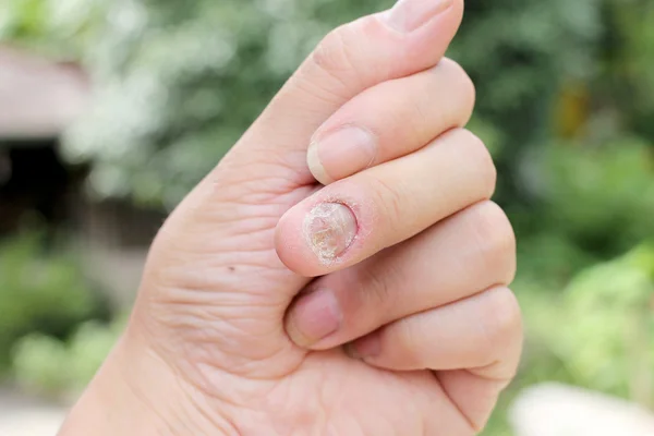 Грибковая инфекция на ладони, палец с онихомикозом, грибок на ногтях. - мягкая направленность — стоковое фото