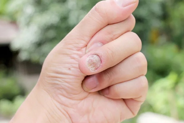 Infecção por fungos nas unhas Mão, dedo com onicomicose, um fungo nas unhas dos pés. - foco suave — Fotografia de Stock