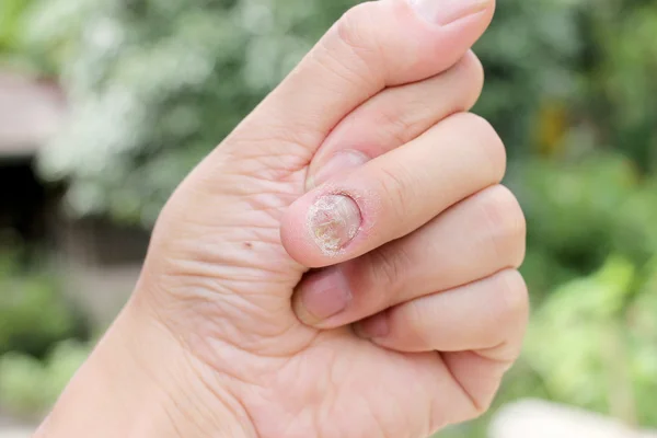 Infektion på naglar Hand, Finger med onychomycosis, en tånagelsvamp. -mjukt fokus — Stockfoto