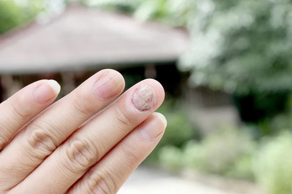 Fungus Infection on Nails Hand, Finger with onychomycosis, A toenail fungus. - soft focus — Stock Photo, Image