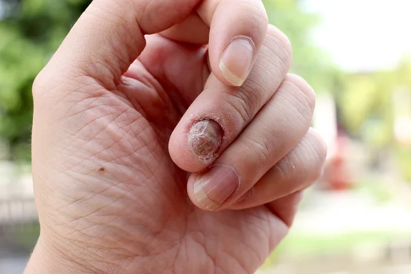Infection fongique sur les ongles Main, Doigt avec onychomycose, Un champignon ongle du pied. - mise au point — Photo