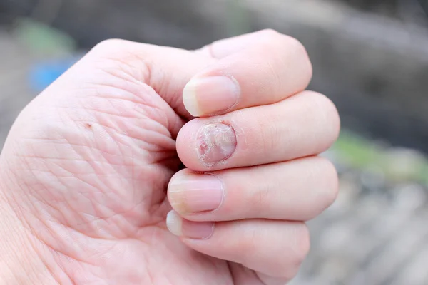 Μύκητα λοίμωξη στο χέρι με νύχια, δάχτυλο με ονυχομυκητίαση. -απαλή εστίαση — Φωτογραφία Αρχείου