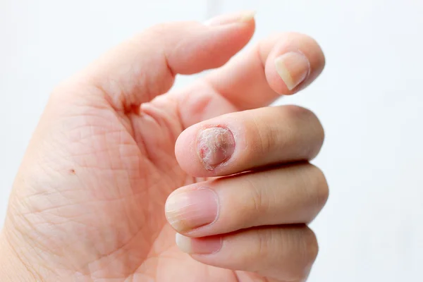 Infezione da funghi sulla mano ungueale, dito con onicomicosi. - soft focus — Foto Stock