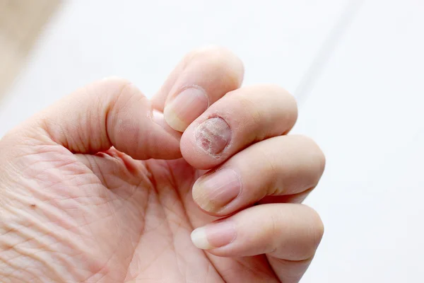 Schimmel infectie op nagels Hand, vinger met onychomycosis. -soft focus Sea... — Stockfoto