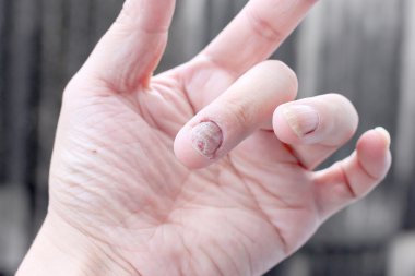 Çivi yandan, parmak Onikomikoz ile mantar enfeksiyonu. -yumuşak odak