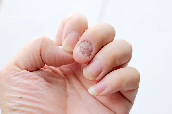 Infecção fúngica nas unhas Mão, dedo com onicomicose. - foco suave — Fotografia de Stock