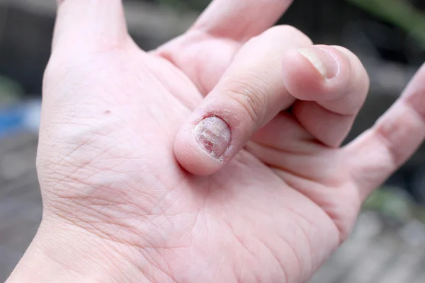 Infecção fúngica nas unhas Mão, dedo com onicomicose. - foco suave — Fotografia de Stock