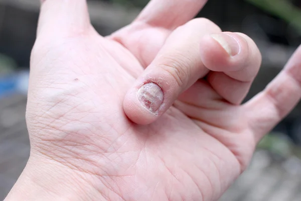 Fungus Infection on Nails Hand, Finger with onychomycosis. - soft focus — Stock Photo, Image