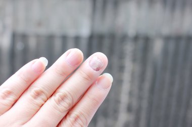 Çivi yandan, parmak Onikomikoz ile mantar enfeksiyonu. -yumuşak odak