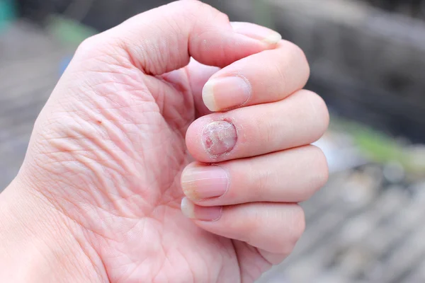 Houbové infekce na nehty ruky, prst s onychomykózy. -měkké zaměření — Stock fotografie