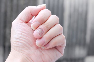 Çivi yandan, parmak Onikomikoz ile mantar enfeksiyonu. -yumuşak odak