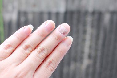 Çivi yandan, parmak Onikomikoz ile mantar enfeksiyonu. -yumuşak odak