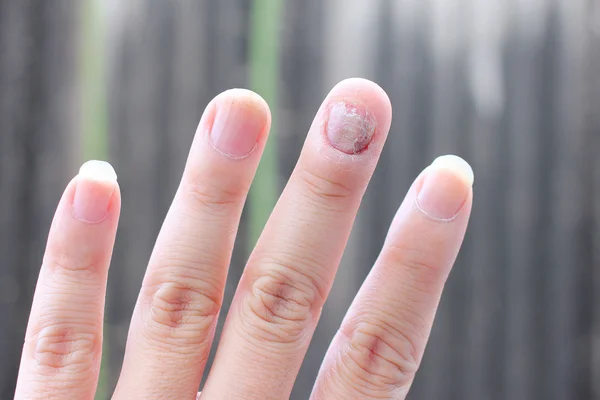 fungus köröm dermatofit köröm gomba, hogyan lehet a legjobban kezelni
