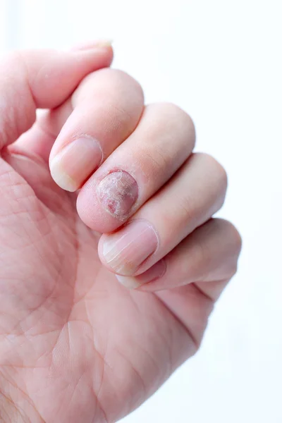 Fungus Infection on Nails Hand, Finger with onychomycosis. - soft focus — Stock Photo, Image